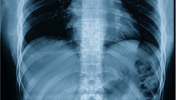 Anklosing-Spondylitis